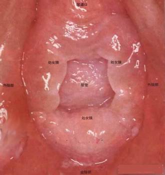 妇科过敏性阴道炎总复发原因